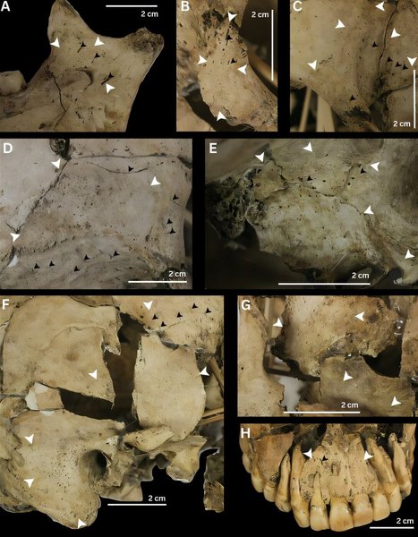 хвороба кістки останки скелет археологія Останки мали сліди хронічних захворювань